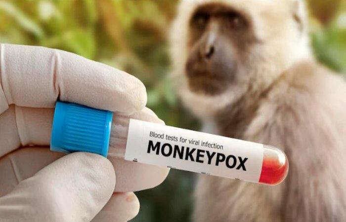 卫生部称中爪哇一名居民疑似感染猴痘