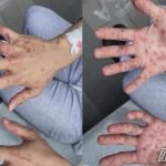 重庆市确诊首宗境外输入猴痘病例