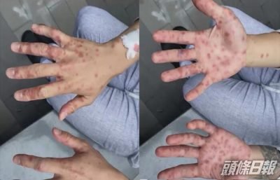 重庆市确诊首宗境外输入猴痘病例