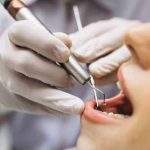 何时该考虑植牙？ 牙医列4大原因